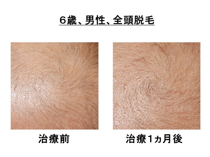 円形脱毛症　病院